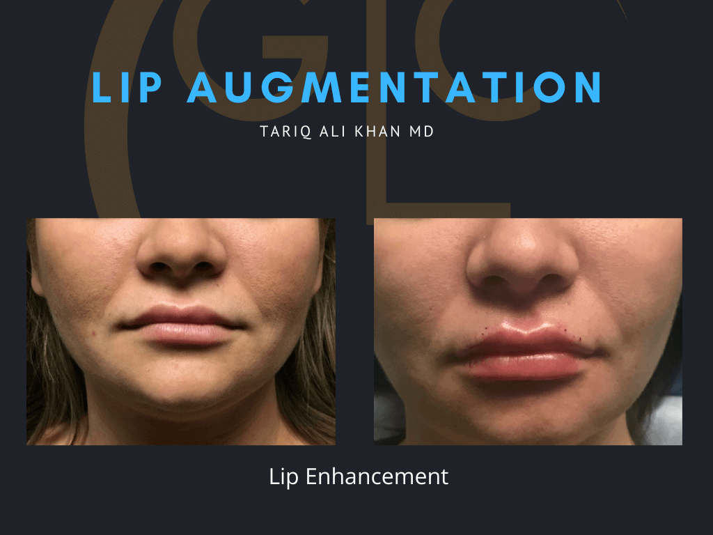 Gentle Care Laser Tustin & Long Beach Before and After picture - Lip Augmentation